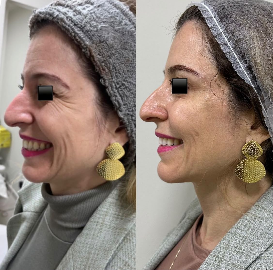 Fotografia real autorizada de evolução facial: antes à esquerda e depois à direita, sem retoques, com a região dos olhos protegida na imagem original.